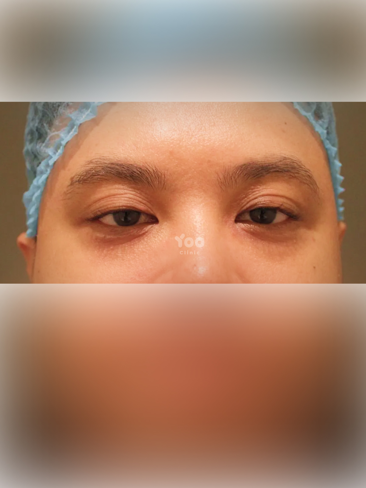 Upper and Lower Blepharoplasty for Refreshed Eyes before