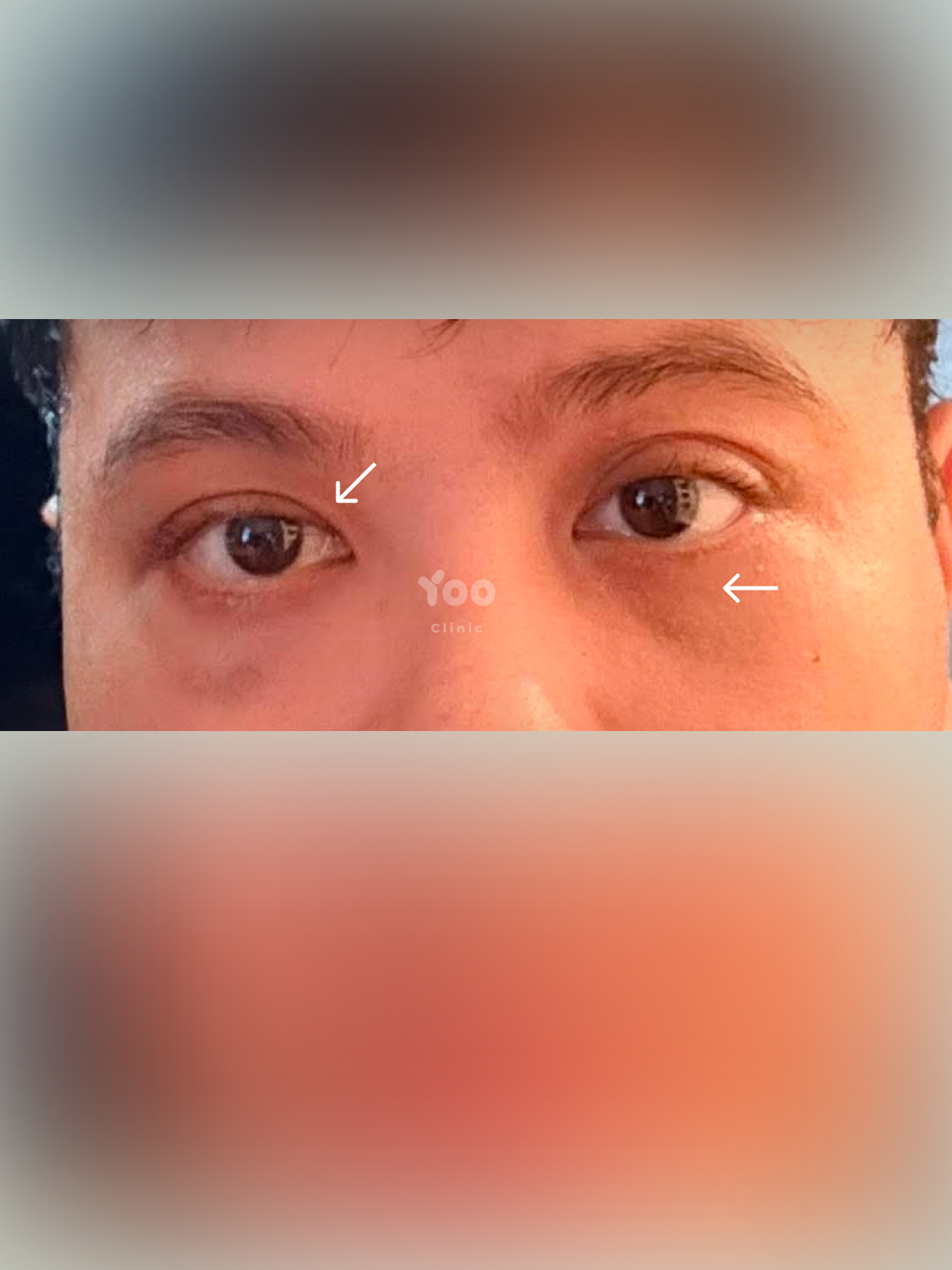 Upper and Lower Blepharoplasty for Refreshed Eyes after